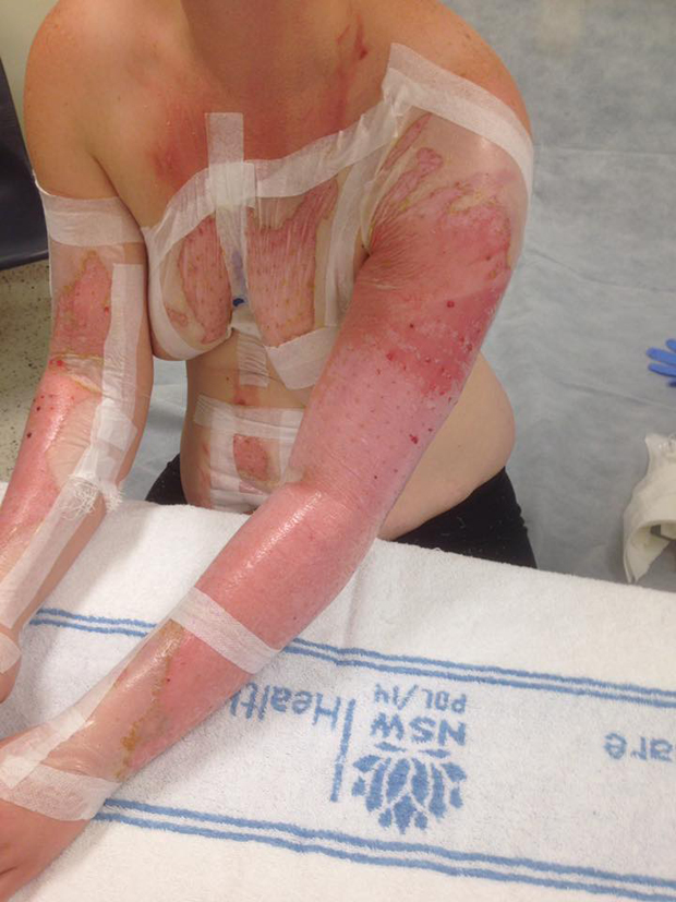 Cassie suffered burns to 12 per cent of her body, but says it could have been much worse. Photo / Facebook / Cassie Hodges